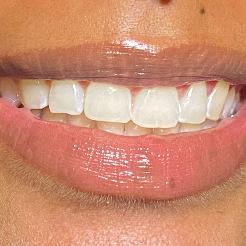 Teeth Whitening at Zen by Zanaya in Chandler, AZ