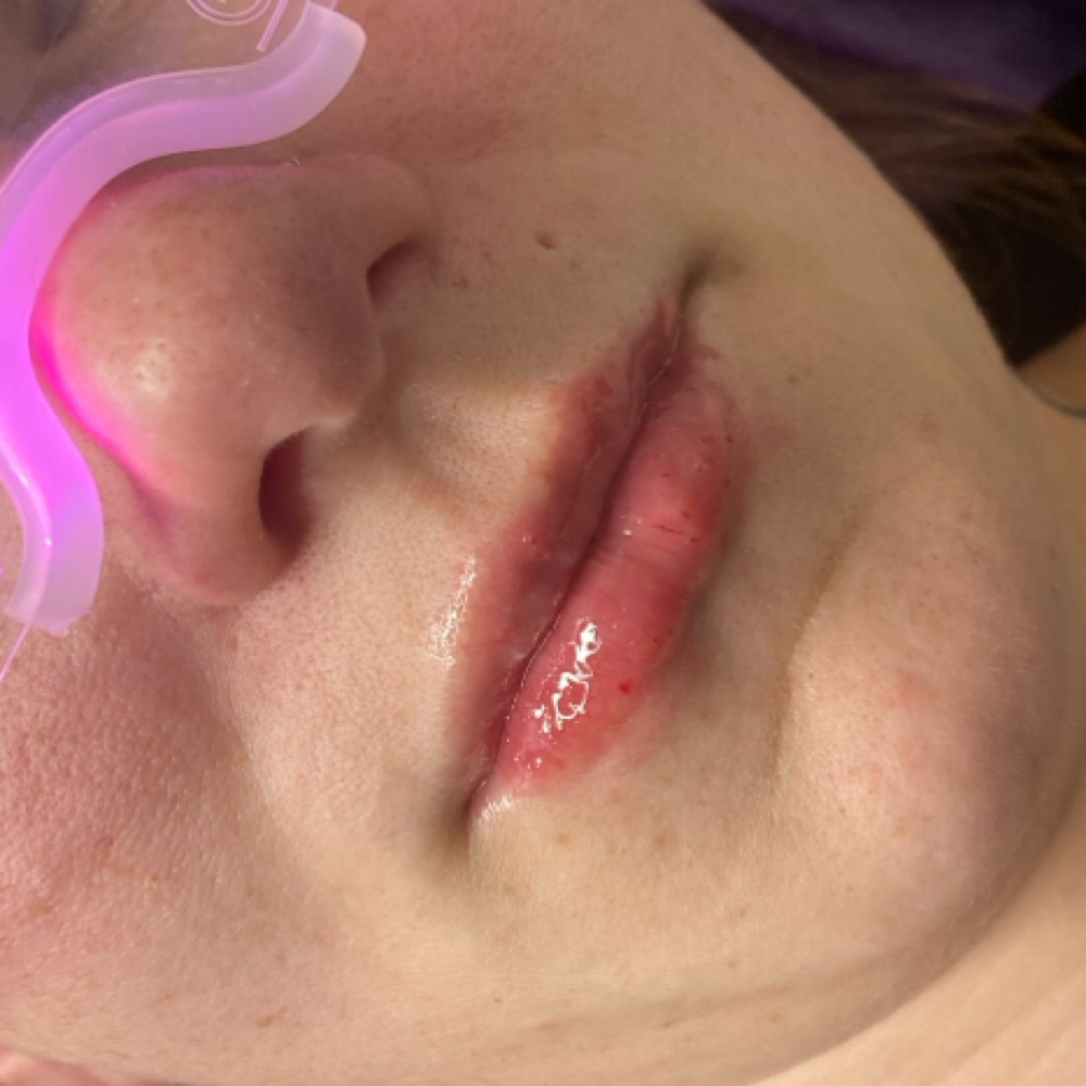 Lip Filler 0.5cc at Glo’s Beauty Creations