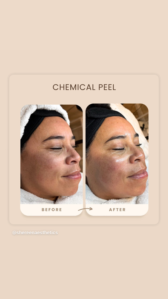 Chemical Peel