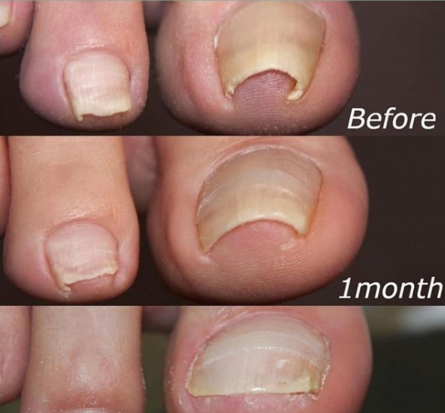 Toenail Brace