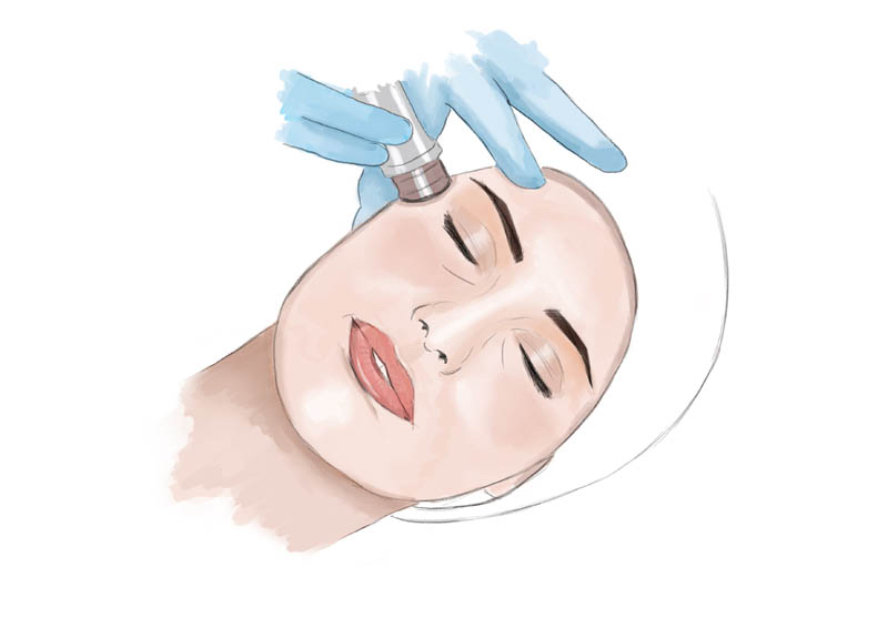 Microdermabrasion