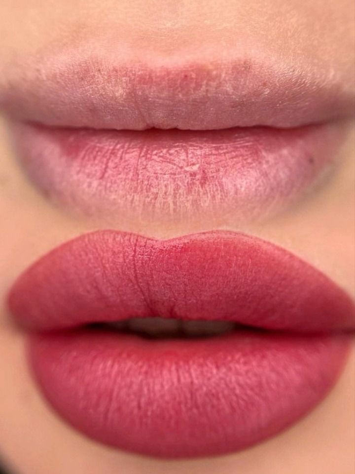 permanent lip removal