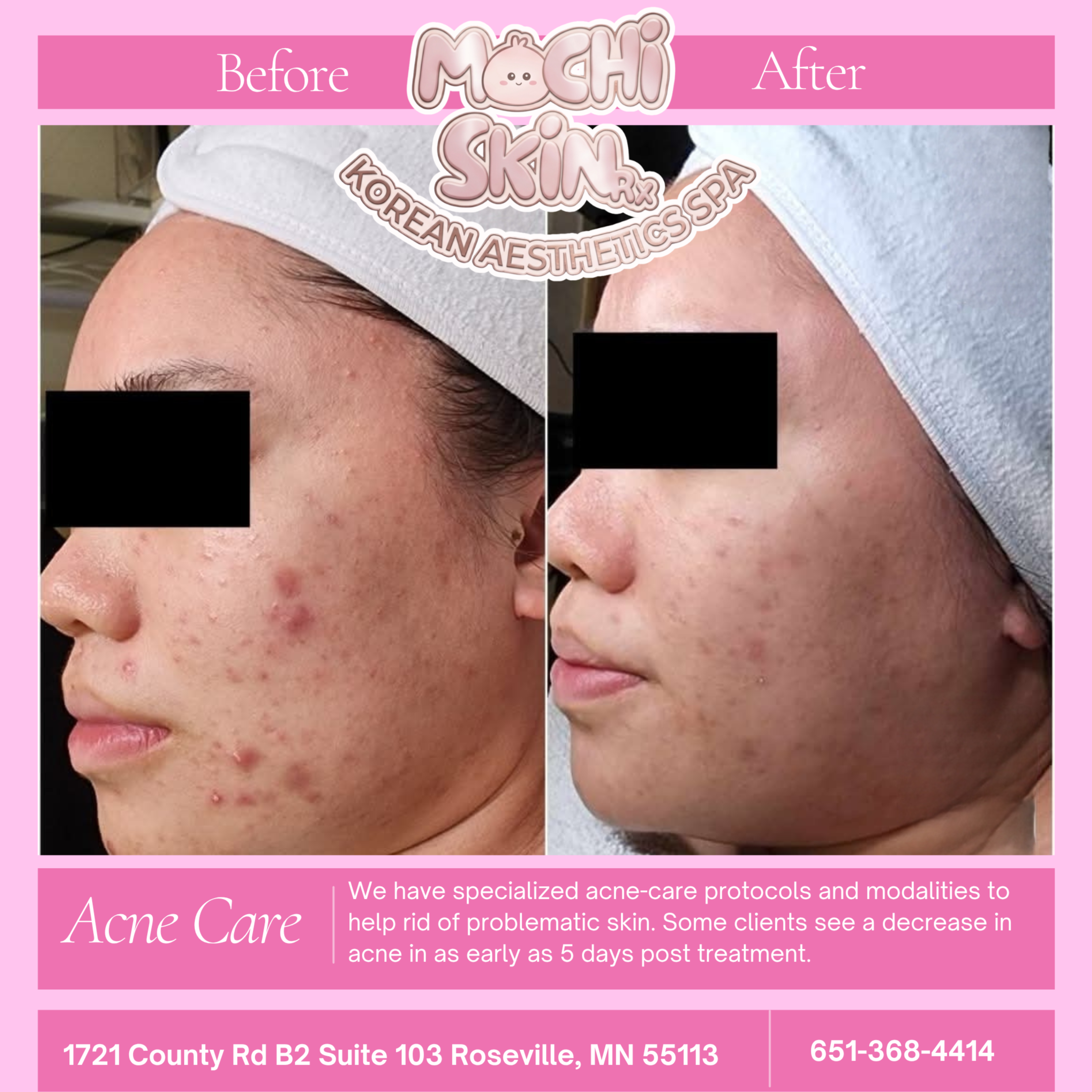 Mochi-Clear (Acne Facial) at Mochi Skin Rx in Roseville, MN
