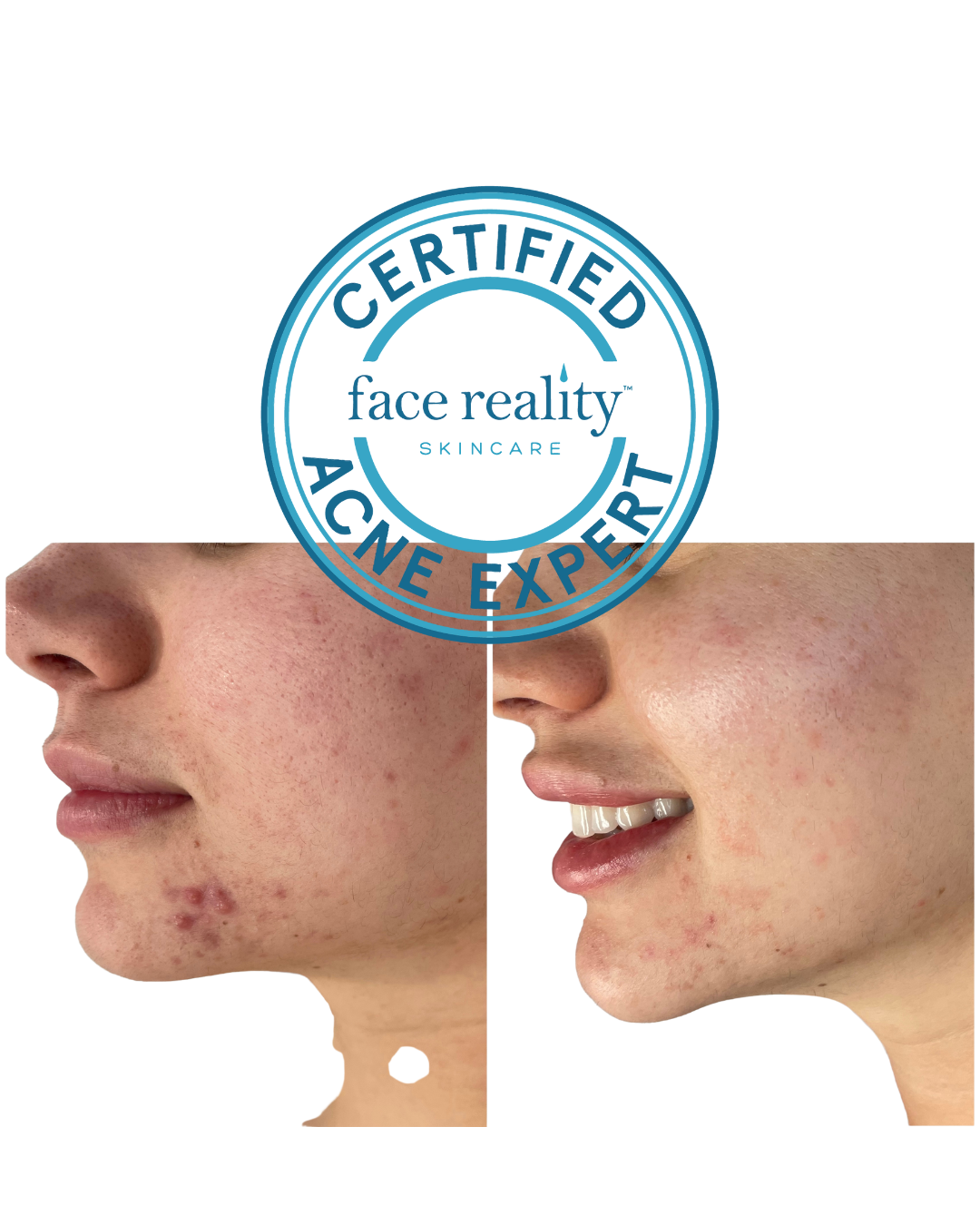 Acne Bootcamp Facial/Peel