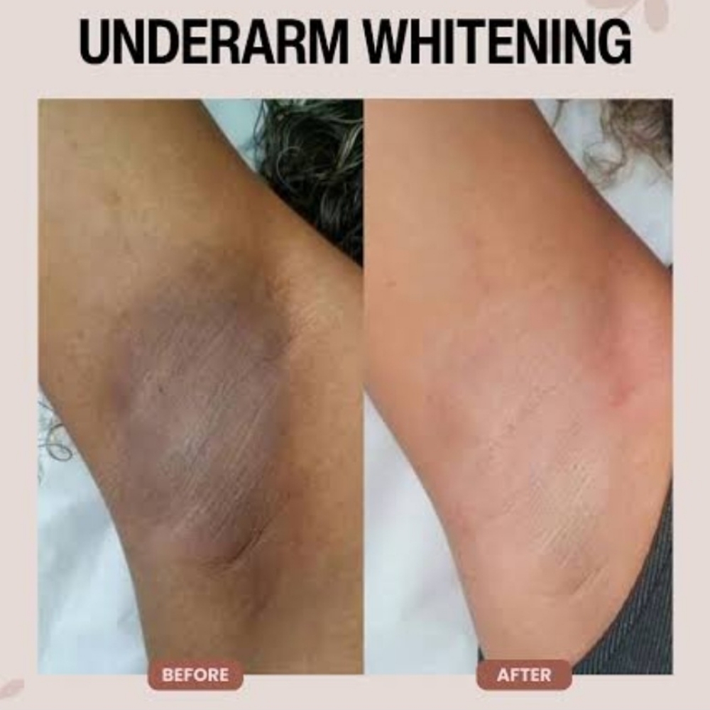 Underarm Whitening Treatment at Fresh n Fab Spa Studio in Anchorage, AK
