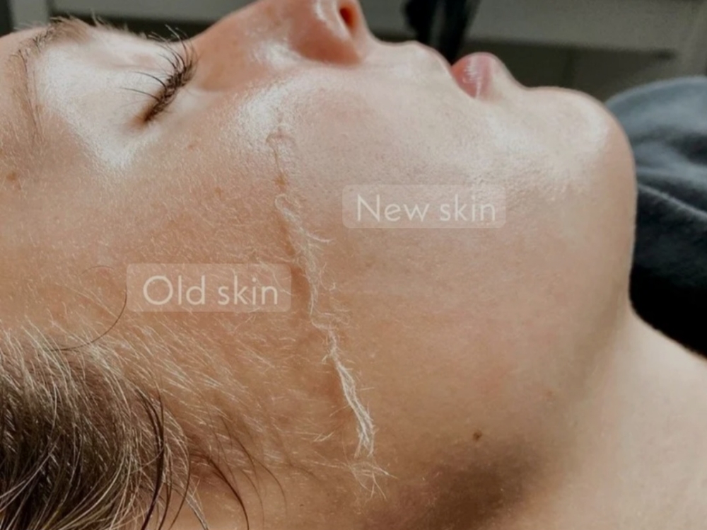 Dermaplaning at Soluna Studio /Beauty & Wellness in Forest Hills, NY