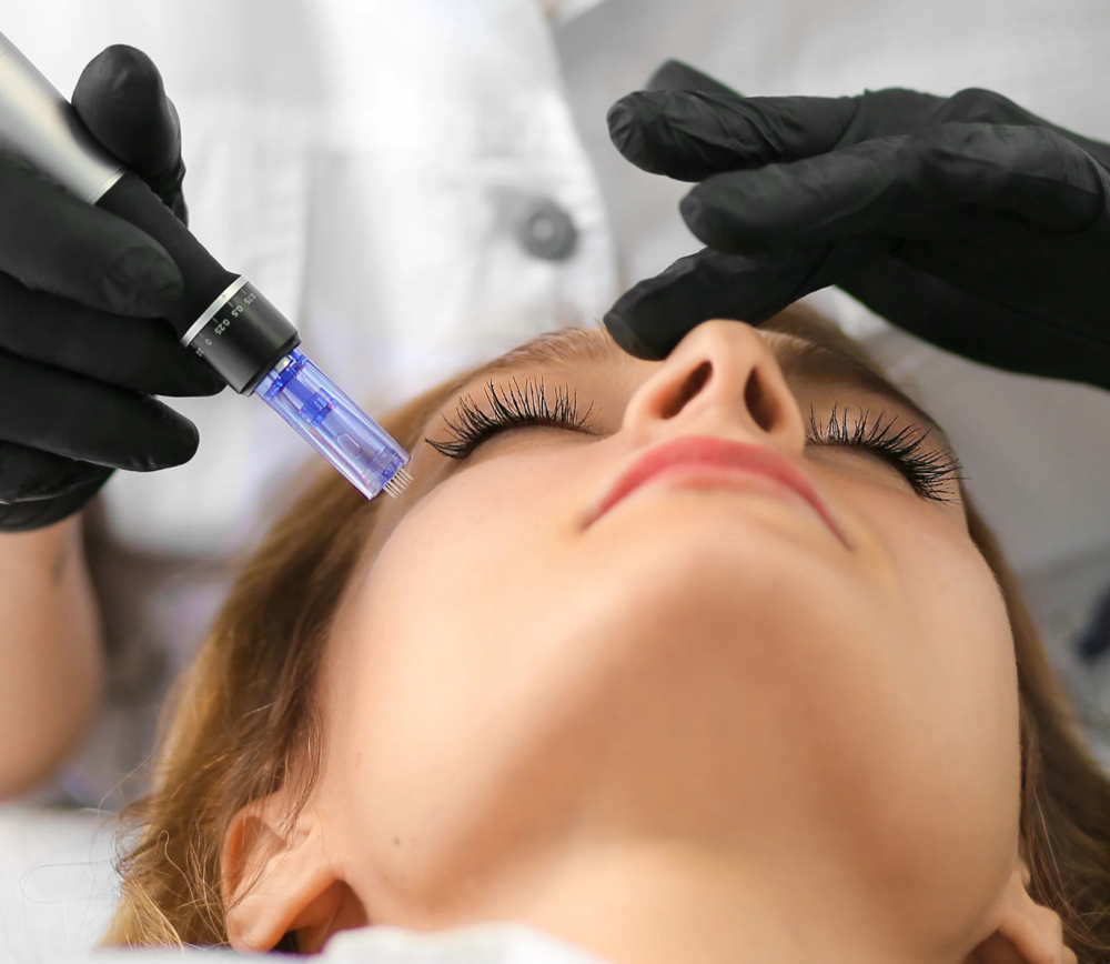 Microneedling