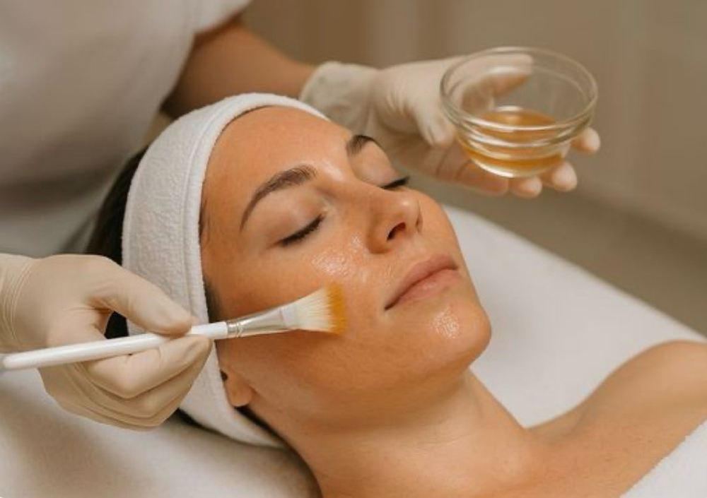 Chemical Peel