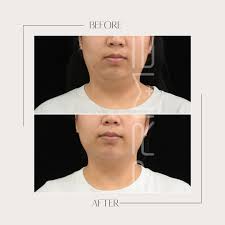 Ultherapy Prime
