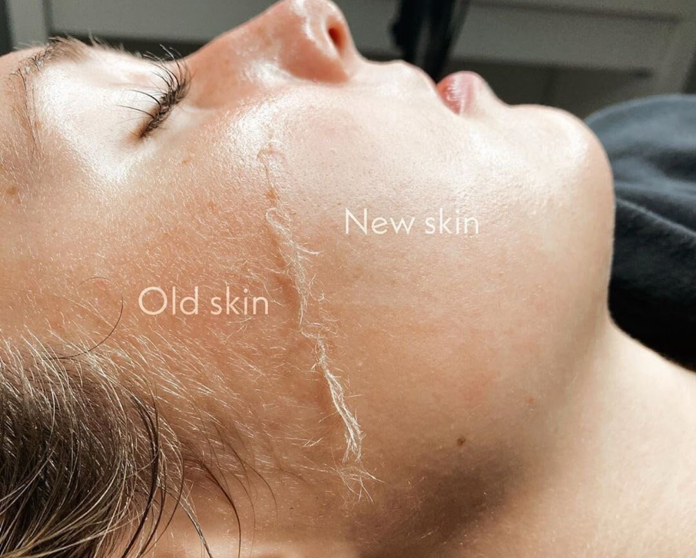 Express Dermaplane