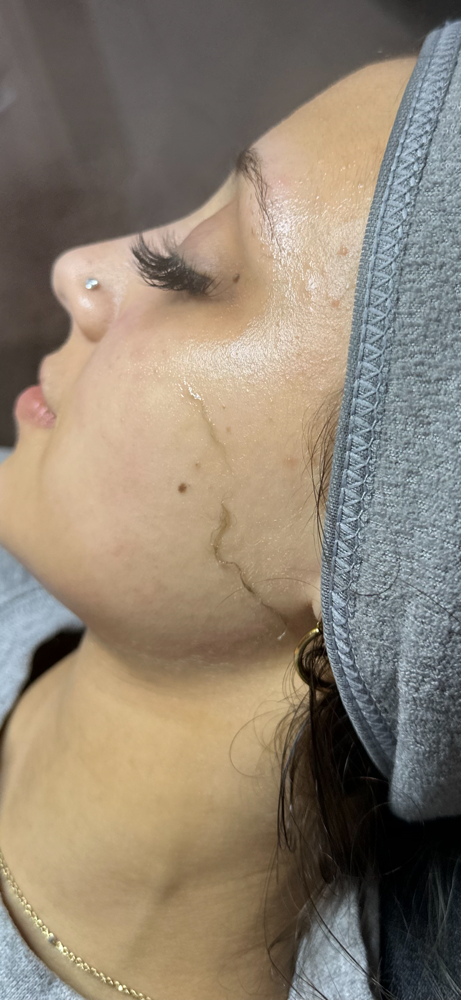 Dermaplane Facial