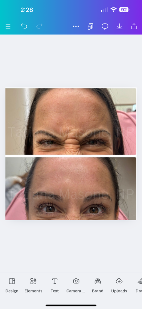 Custom Botox - EXISTING PATIENT