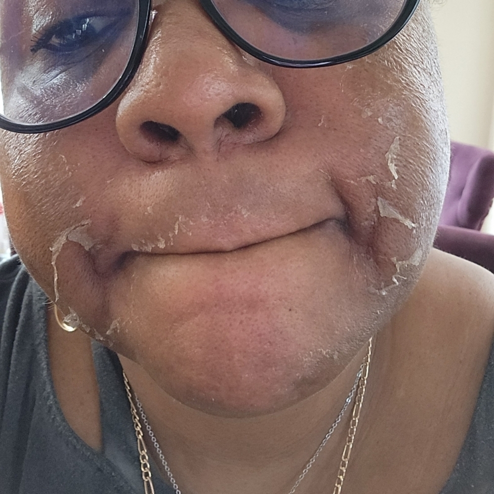 Chemical Peel at Gwen D Esthetics in Lanham, MD