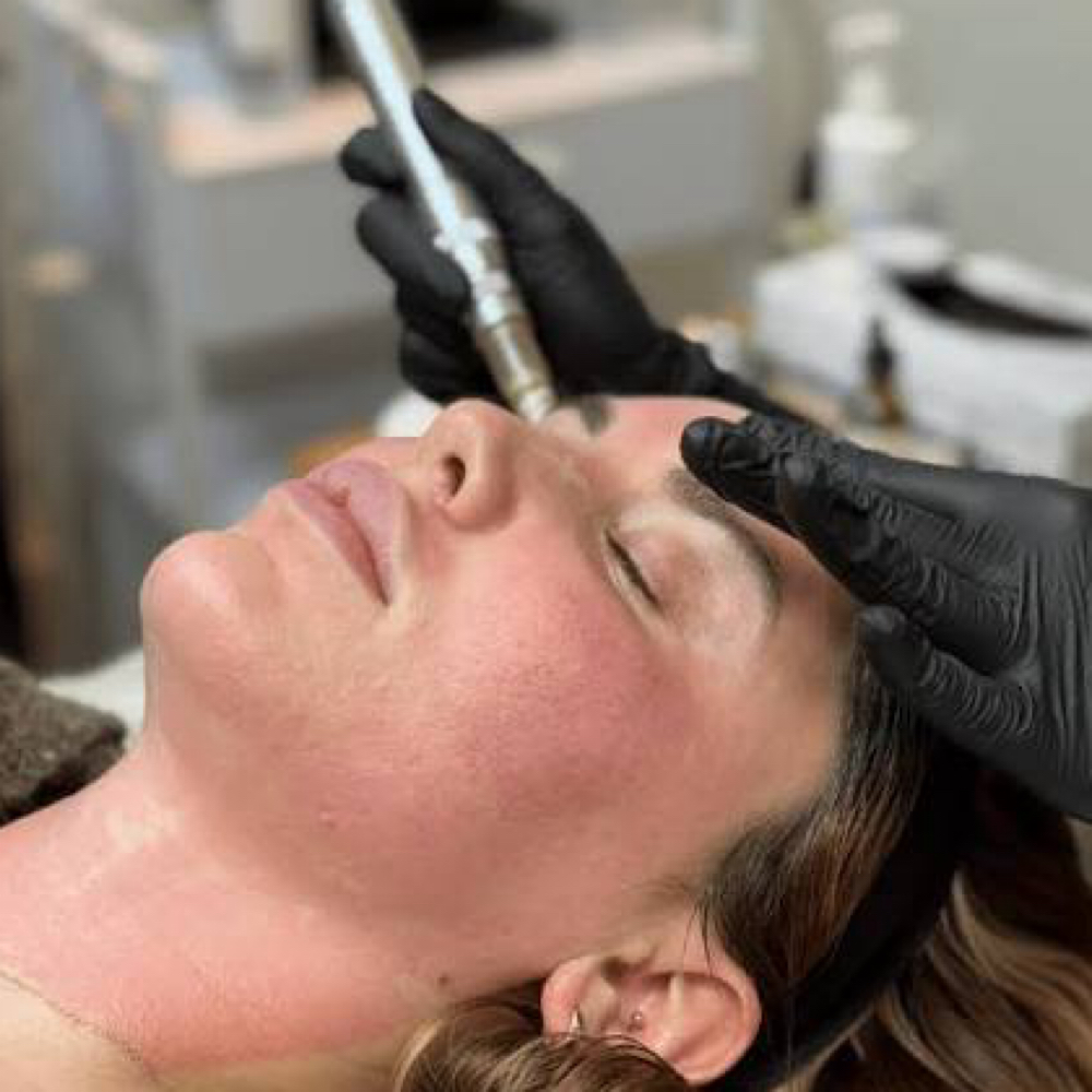 Microneeding at Principled Skin Aesthetics by Annie Reay in Frisco, TX