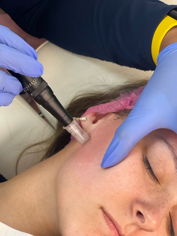Microneedling