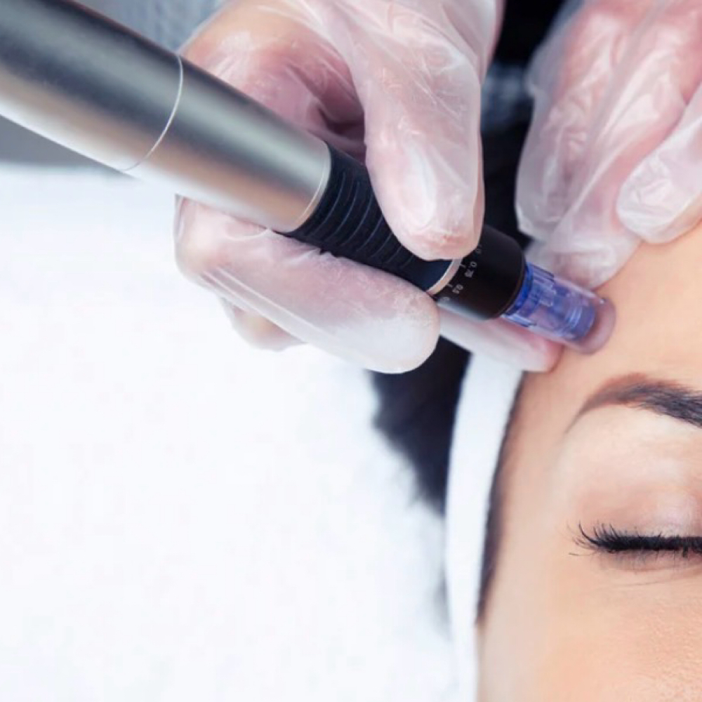 Microneedling Treatment at Halie Jean aesthetics in Marlborough, MA