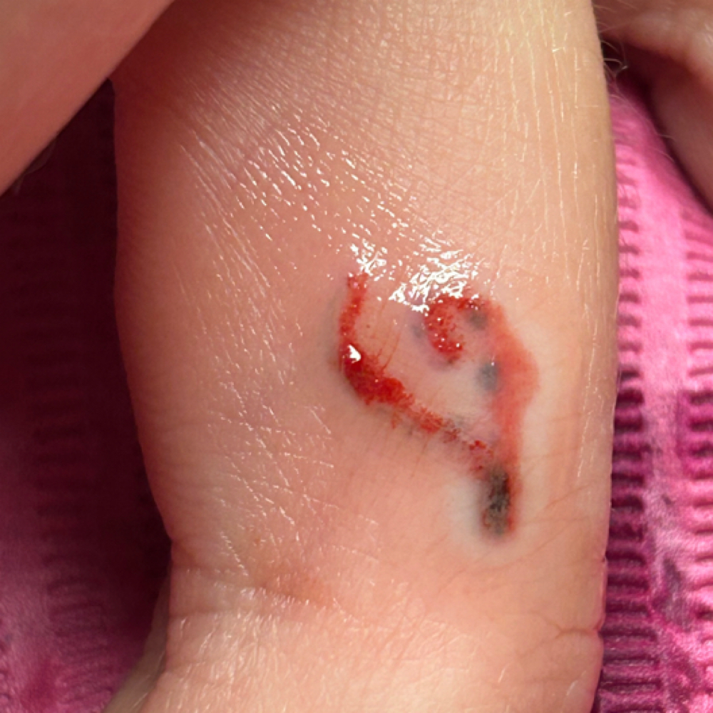 Li-Ft Saline Removal at Pretty In Ink PMU & Electrolysis in Portsmouth, OH