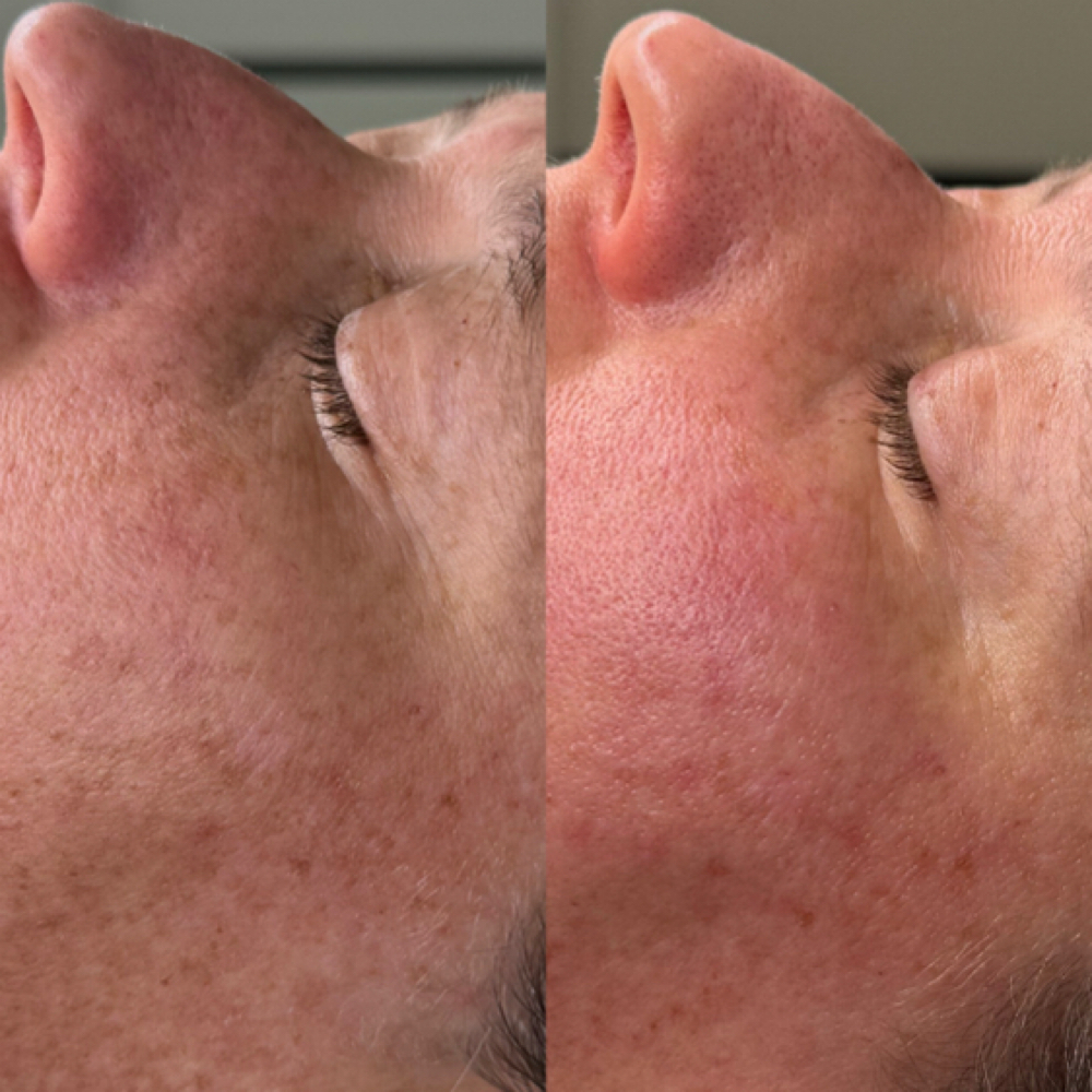 Microchanneling With AnteAGE Serum at Soul to Skin Esthetics in Bend, OR