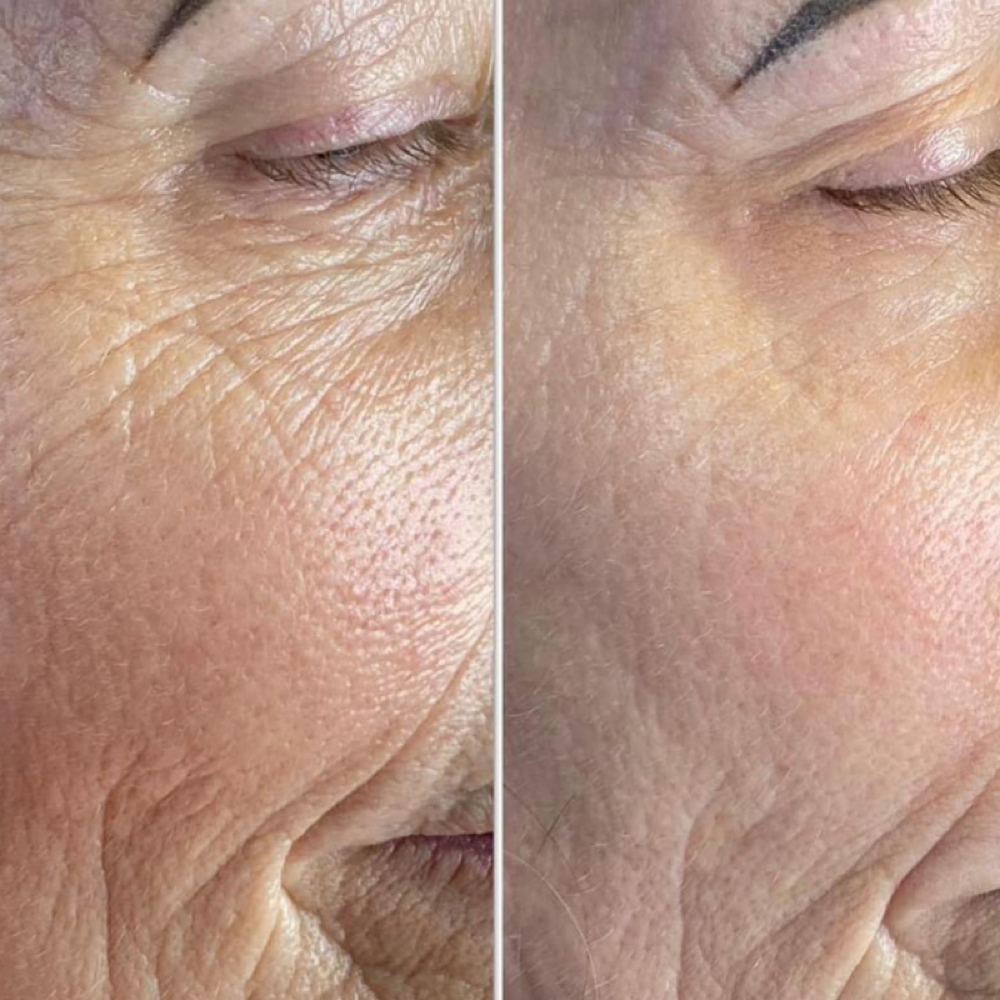 Microchanneling With AnteAGE Serum at Soul to Skin Esthetics in Bend, OR