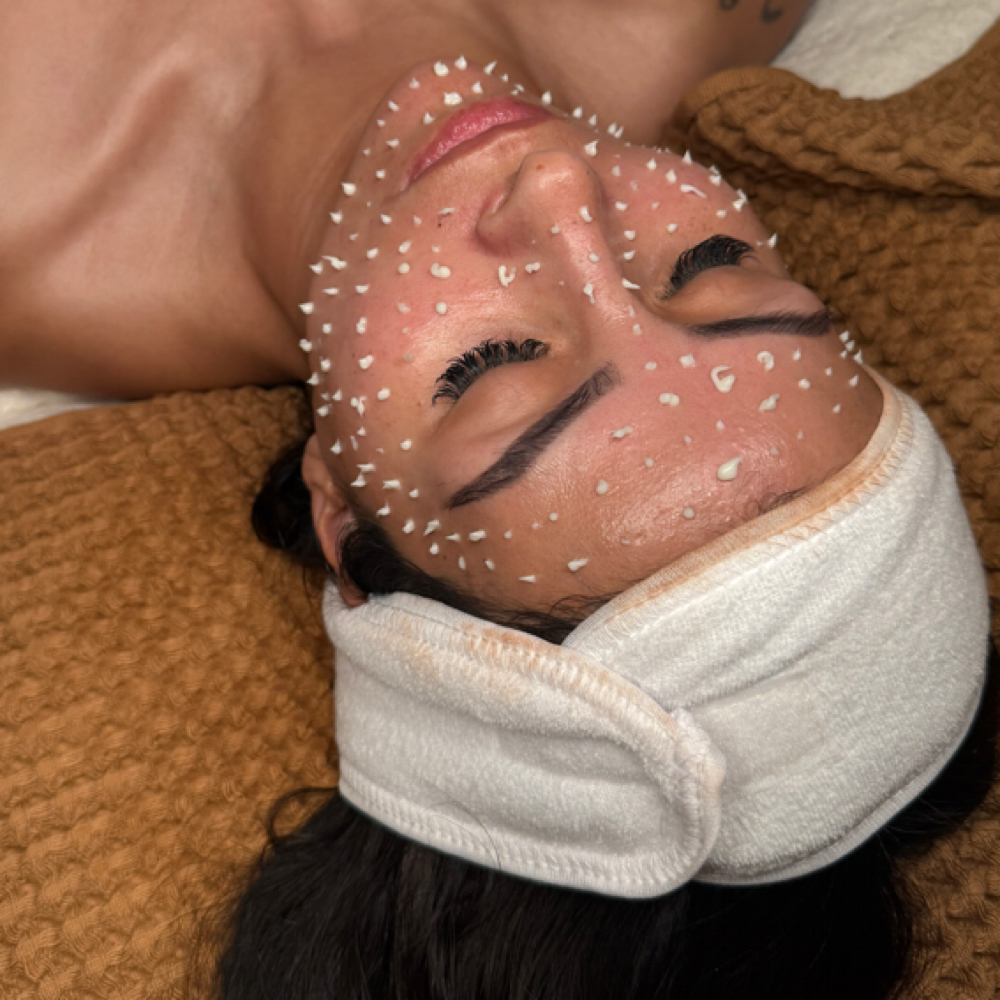 GLASS SKIN MICRONEEDLING at Raesthetics LLC in Fort Morgan, CO
