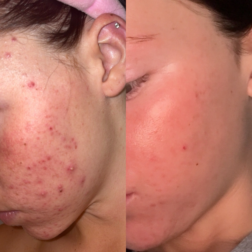 In-Depth Acne Consult & Session 1 at Native Complexions in Winchester, KY