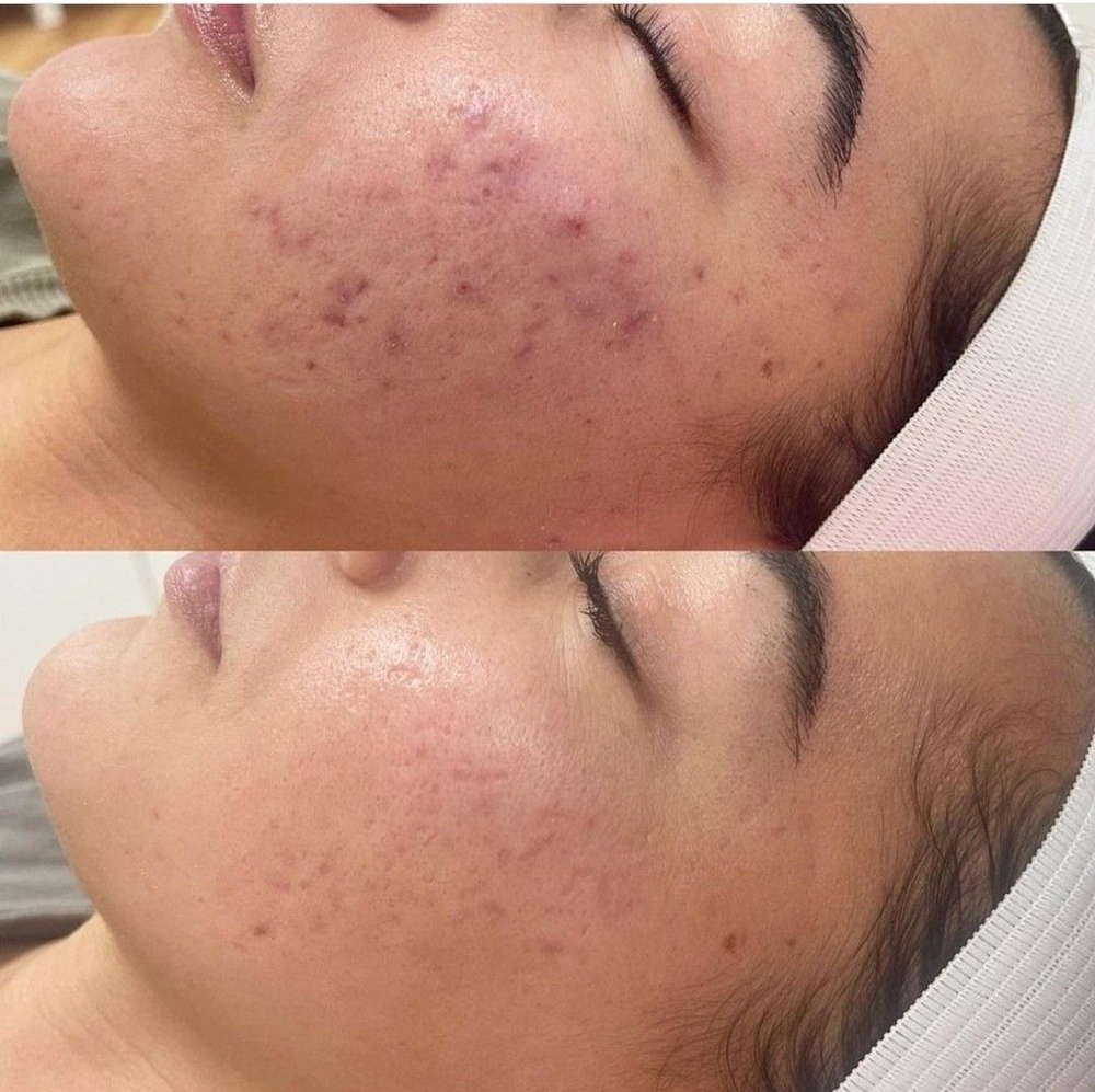 CLARIFYING-ACNE FACIAL at anele skin studio in SUMMERFIELD, NC