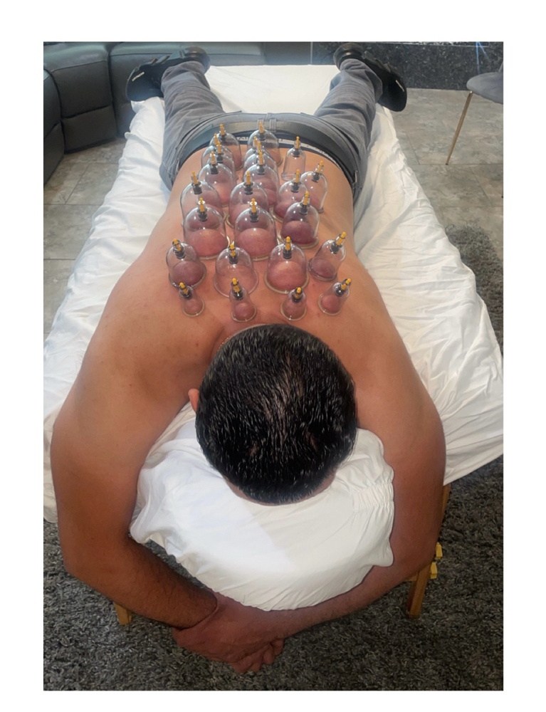 Cupping