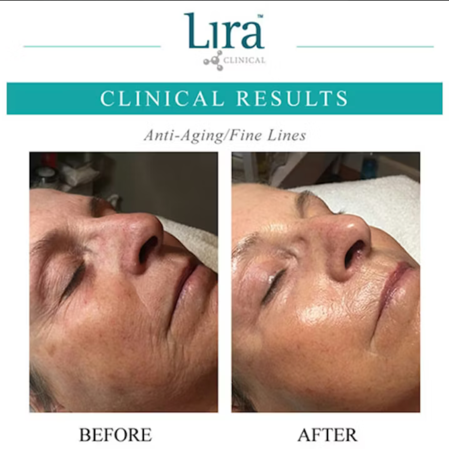 Chemical Peel at Brows, Lashes, Etc. in Lake Stevens, WA