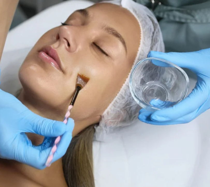 Chemical Peel