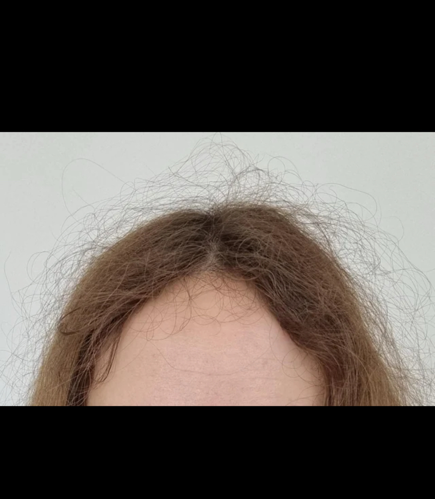 Patial Keratin Smoothing