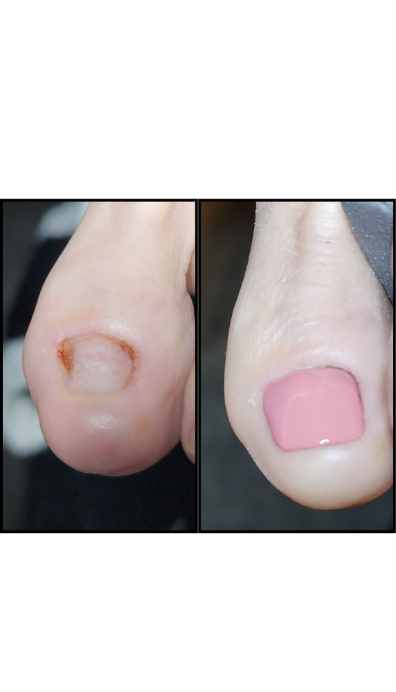 Toenail Reconstruction