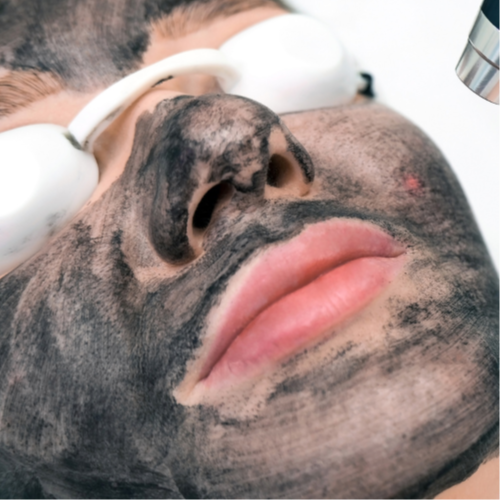 Carbon Mask Laser Facial at Undo Studio in Fort Worth, TX