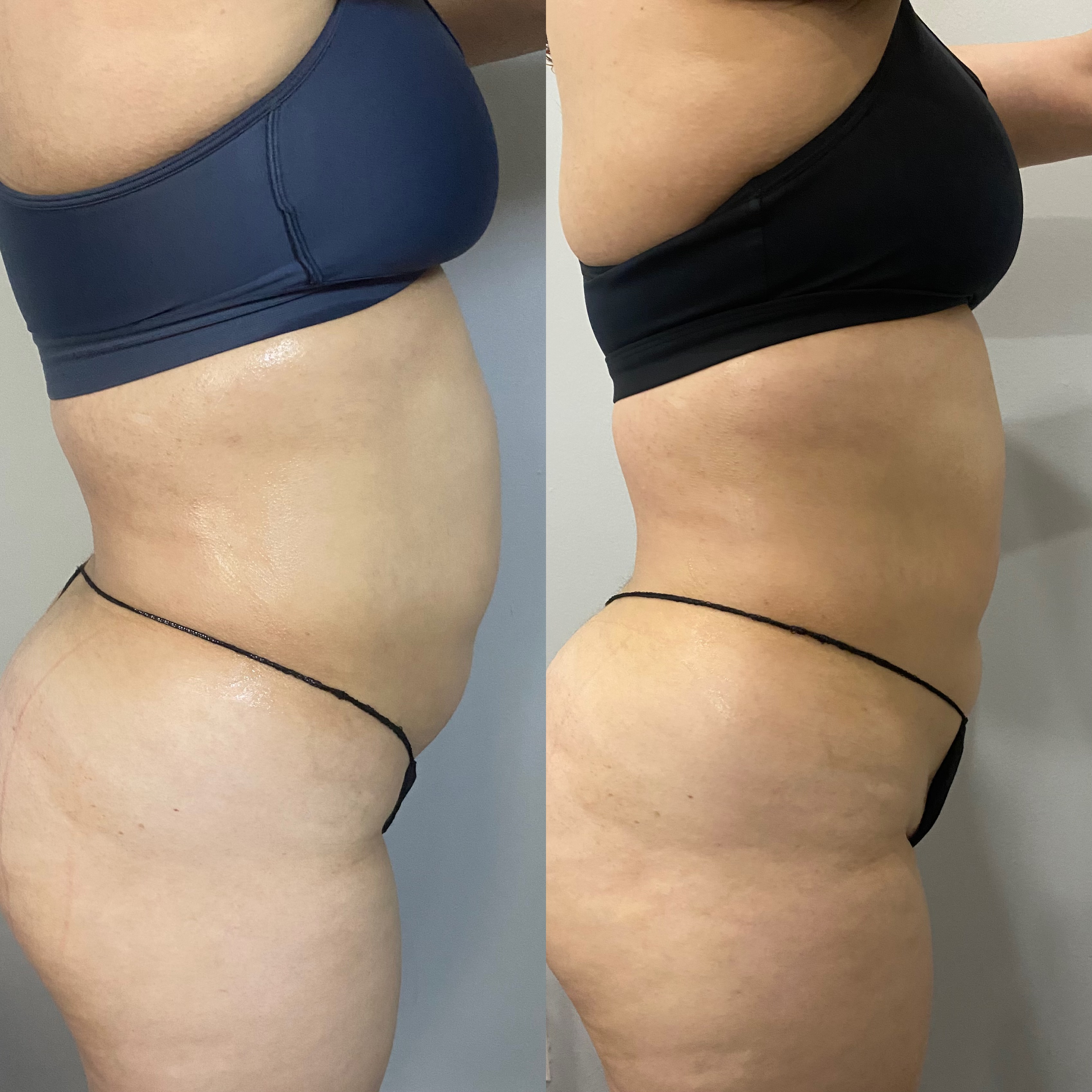 Body contouring treatment