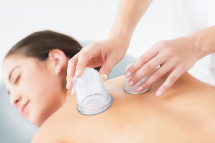 Cupping Therapy