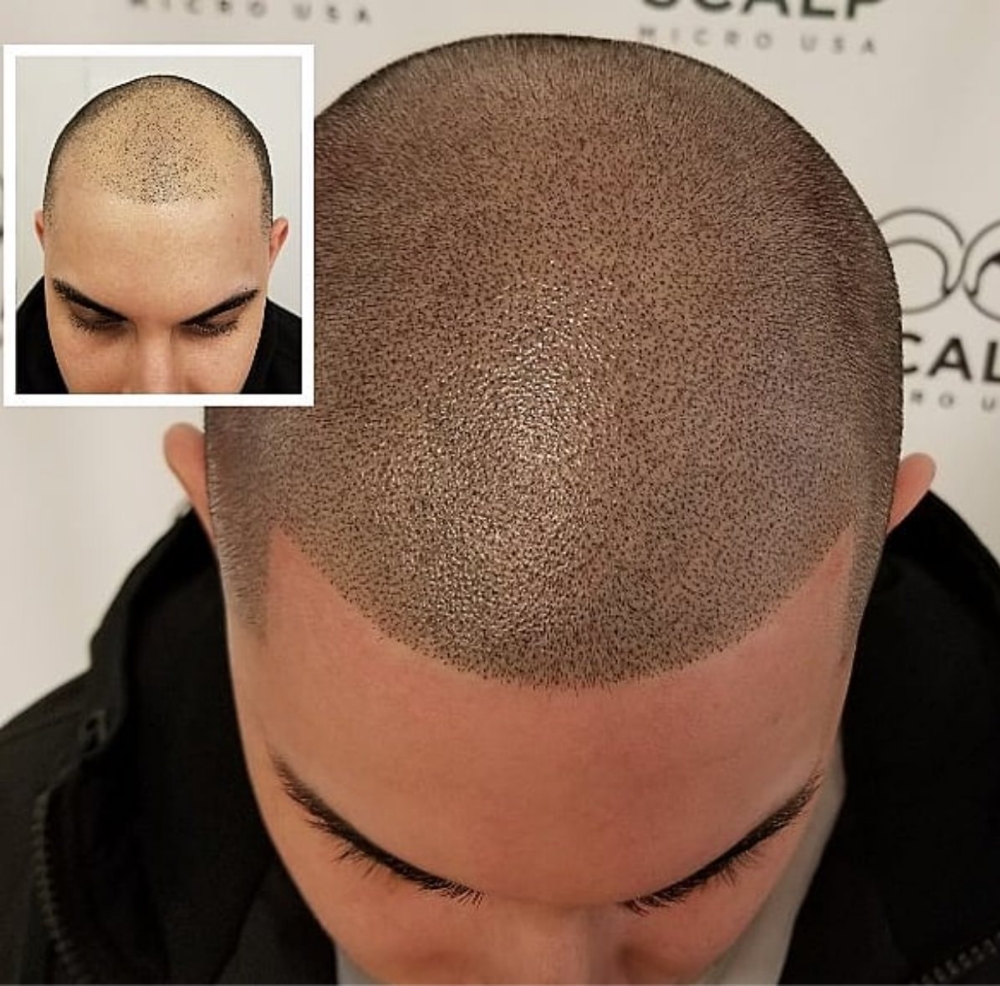 SMP Scalp Micropigmentation