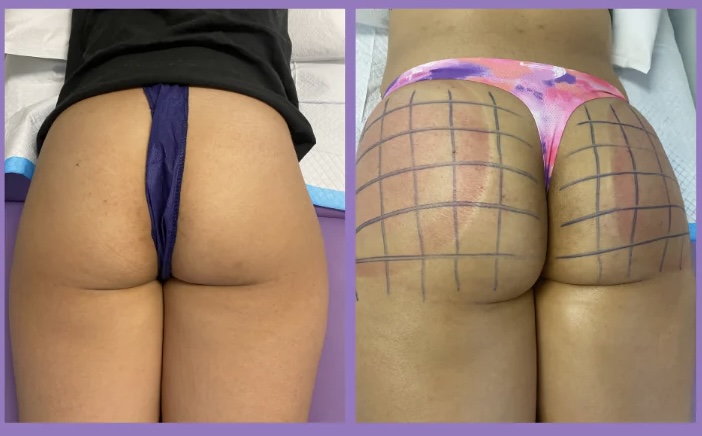 Butt Infusions (Needle-Free)