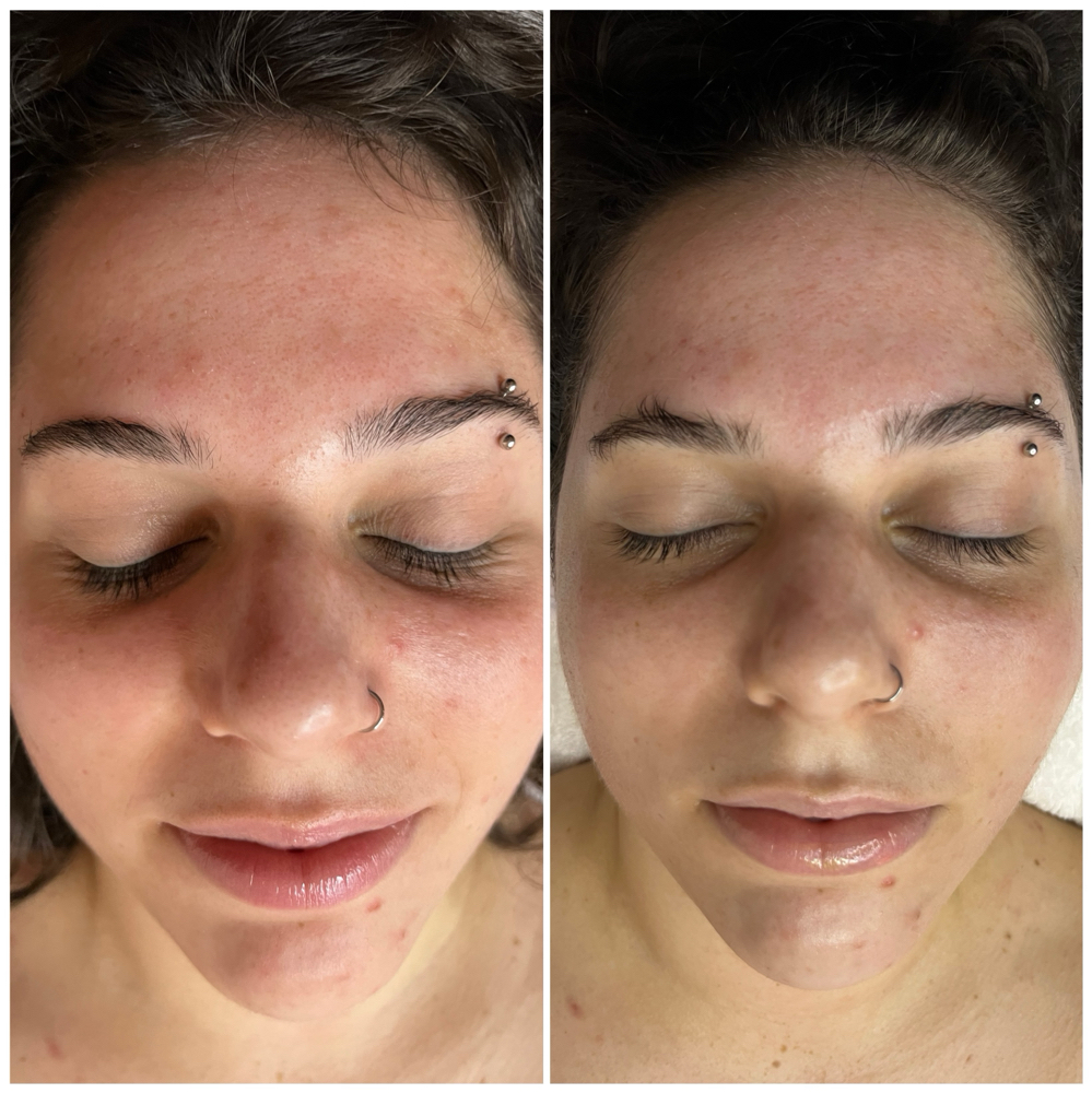 Rosacea/Sensitive Facial