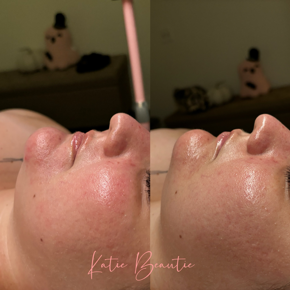 Rosacea/Sensitive Facial