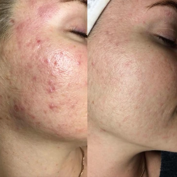 Acne Relief Detox Facial at AGELESS SKIN BY ASEEL MED SPA in Prosper, TX