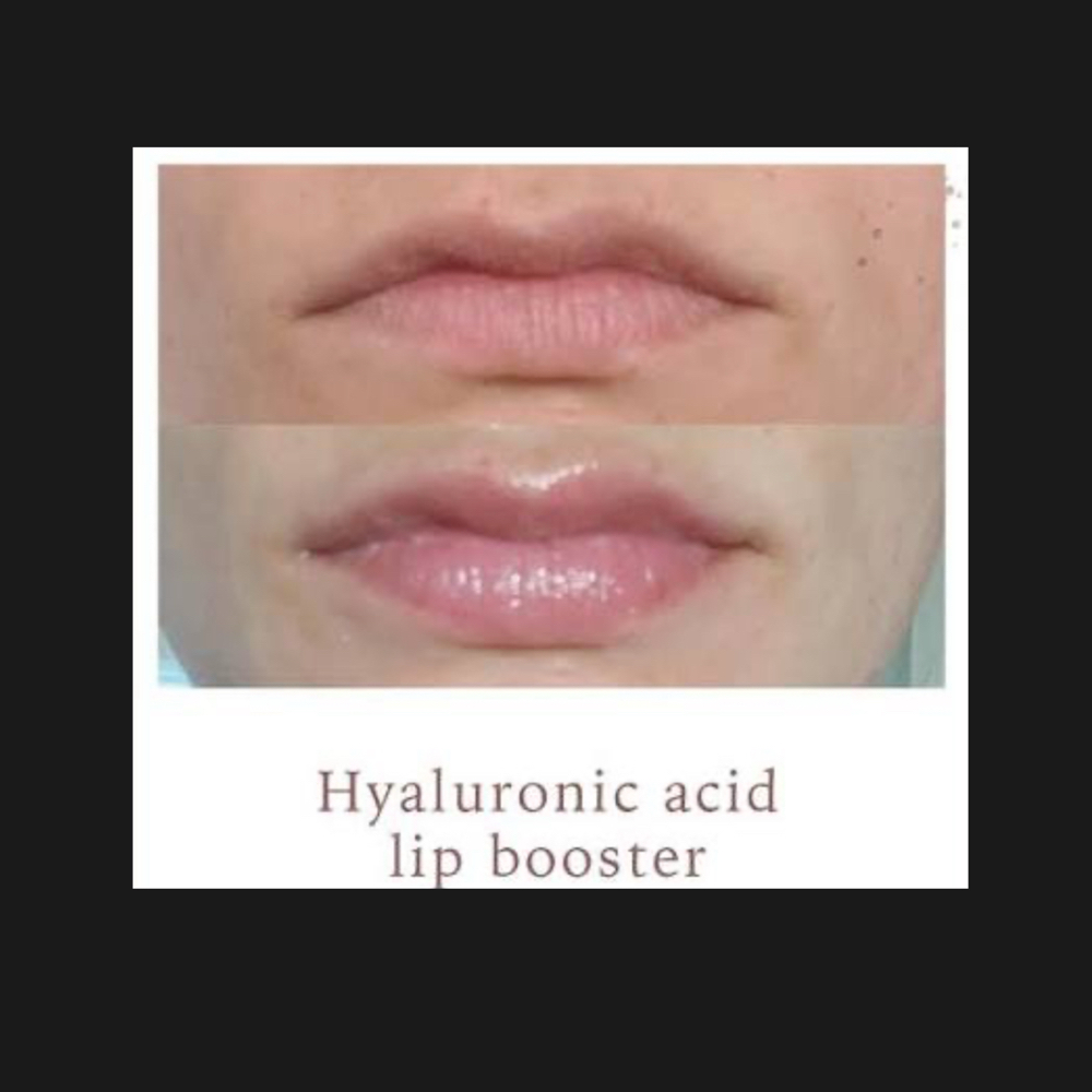 Hyaluronic Lip Treatment