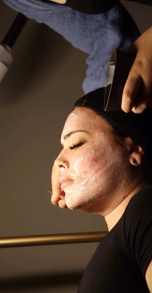 Deep Acne Cleanse Facial