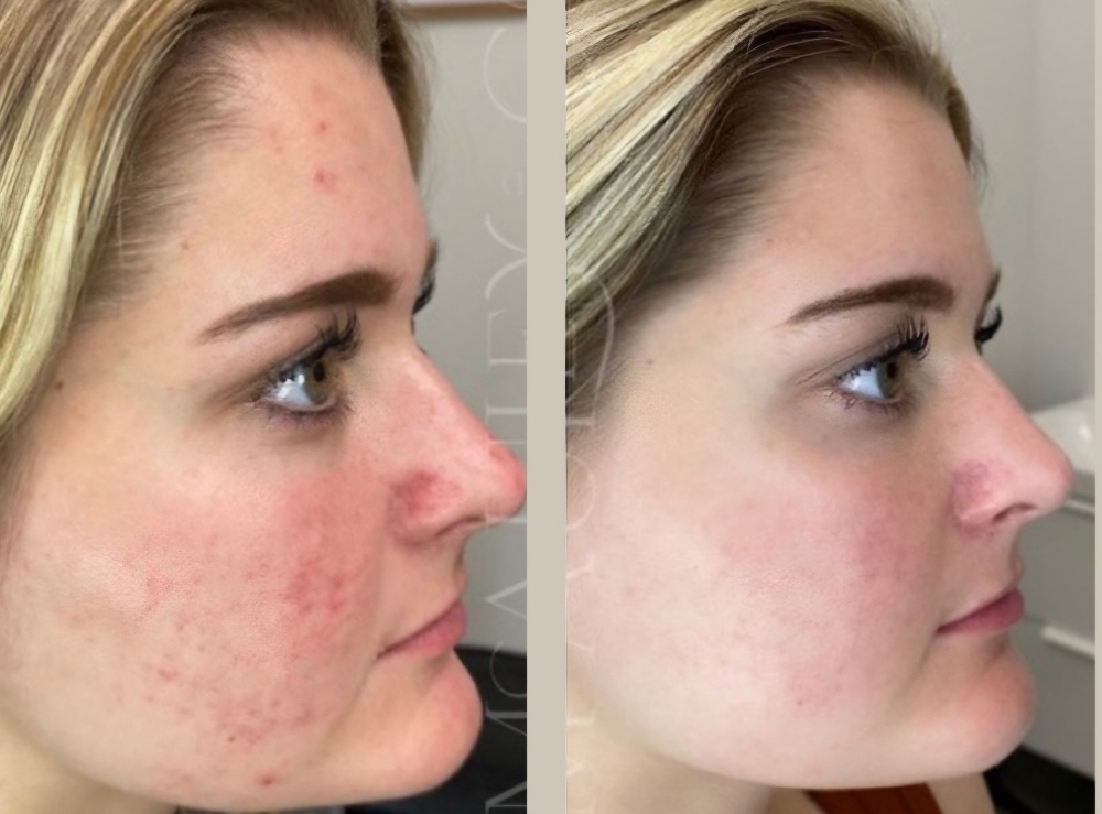 Acne Treatment Series