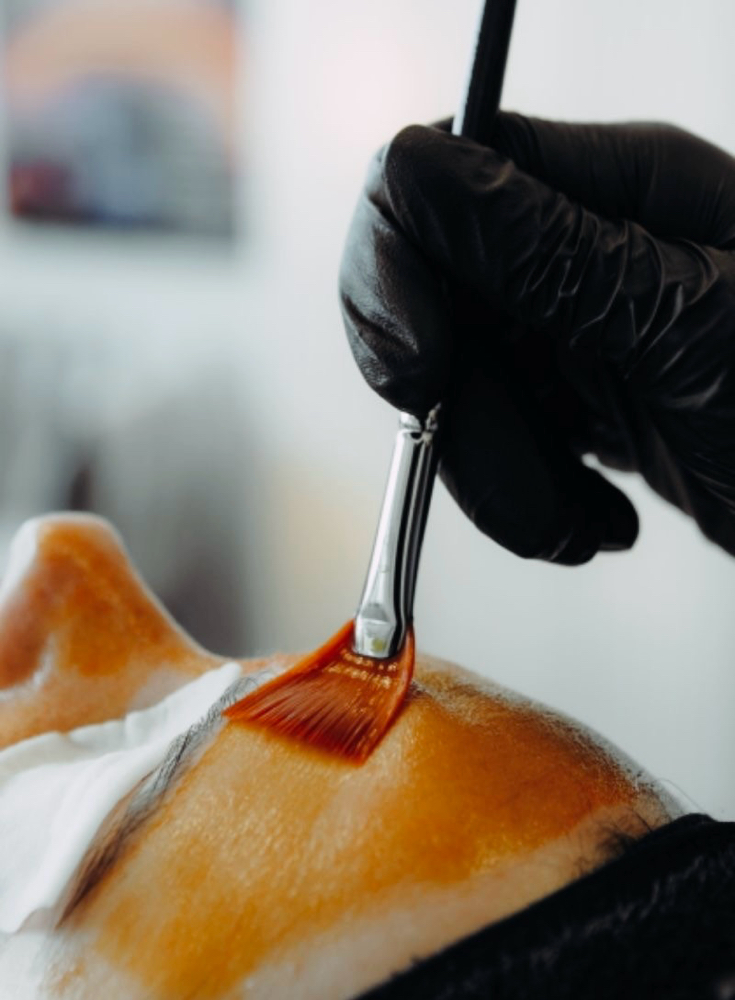 Chemical Peel