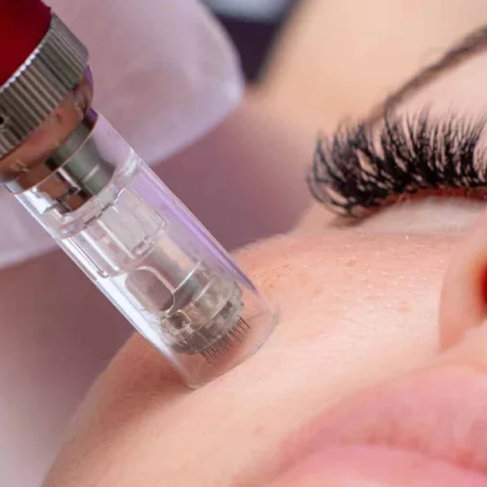 Microneedling X5 Session Package at Sage Esthetics in Pembroke, MA
