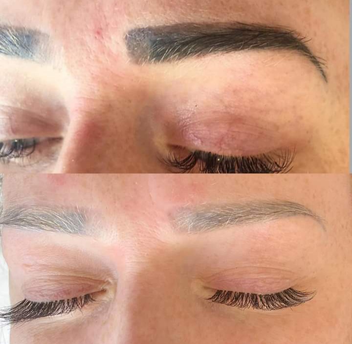 Saline Tattoo Removal