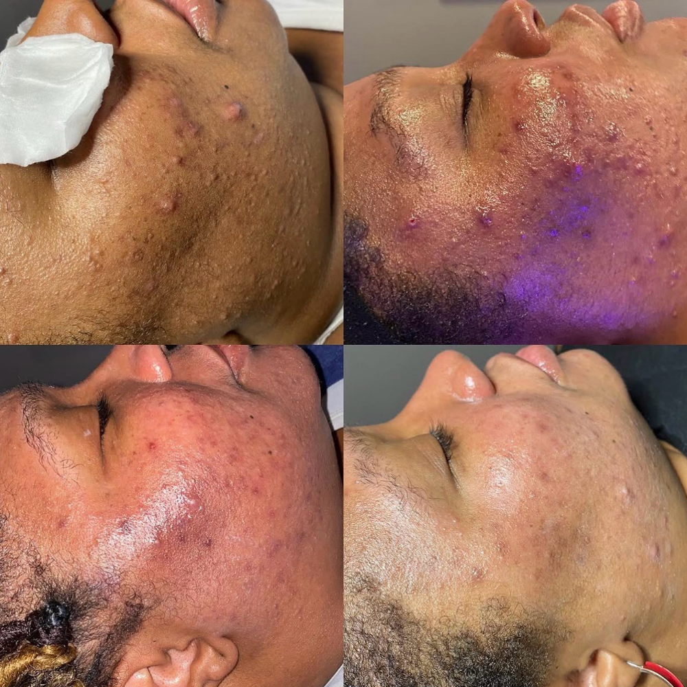 Level 3 - Corrective at The Skinfidence Collective in St. Clair Shores, MI