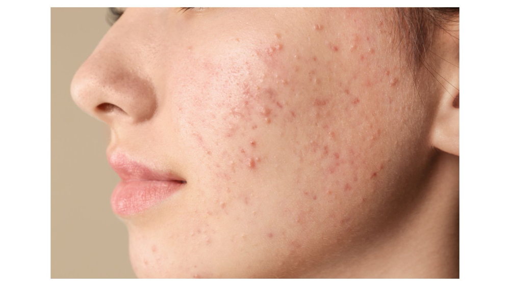 Acne Clarifying Facial