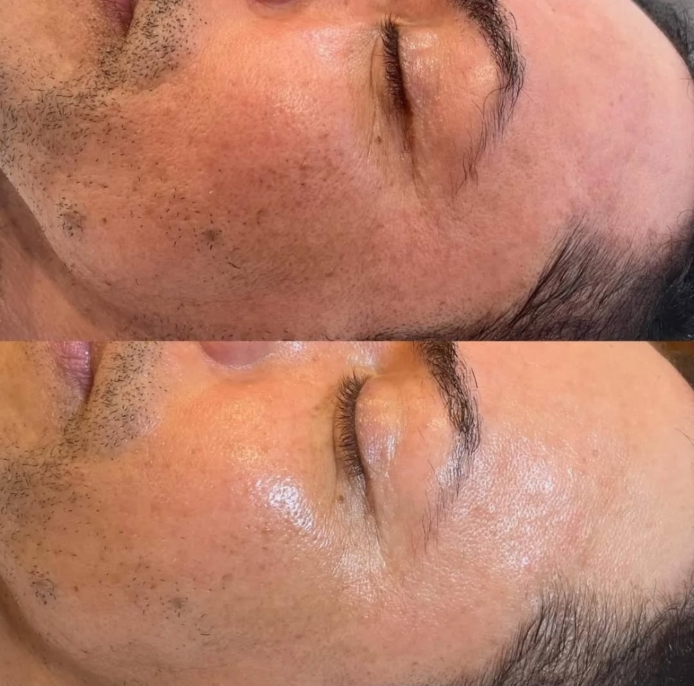 Beyond Botox Anti-aging
