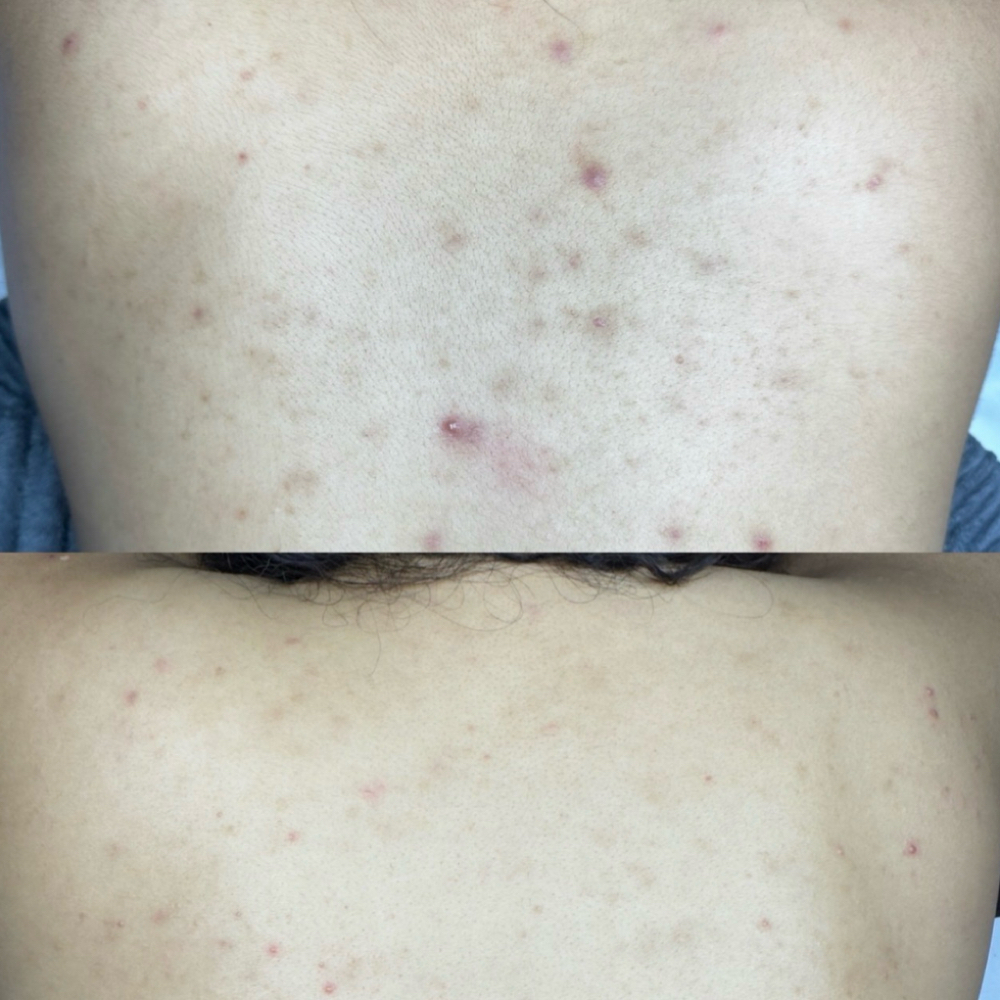 Stubborn Pigment Peel at Skin Seed in Turlock, CA