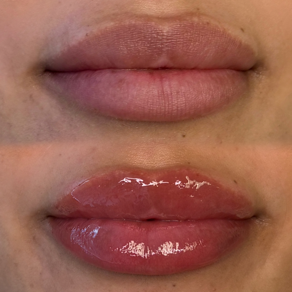 .5mL Microneedle Lip Filler at Seduce Beauty & Academy in Houston, TX